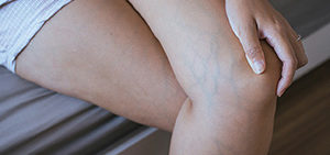 ic-visszerproblemak-nem-csak-idoseket-1